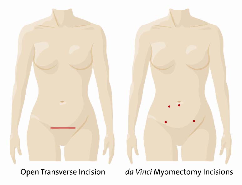 Fibroids img 1