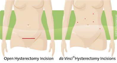 Hysterectomy img 1